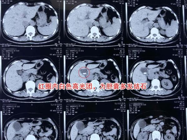 胆囊炎b超图片图片