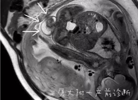 崩溃厦门一女子怀孕5个月发现胎儿竟有尾巴医生说