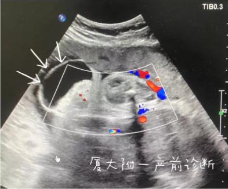 怀孕五个月胎儿彩超图片