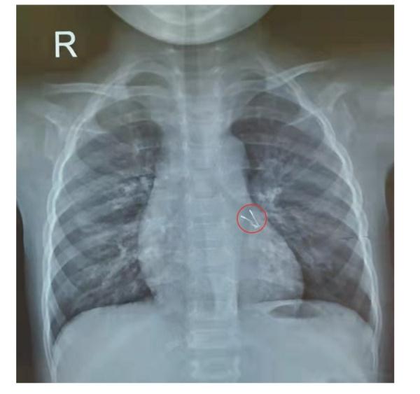 上呼吸道感染诊断证明图片