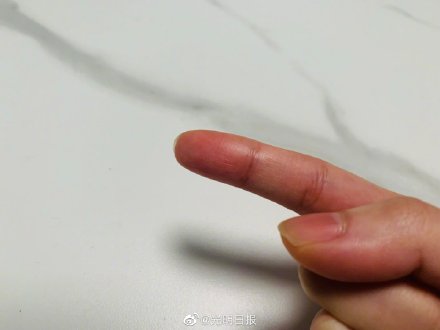 科学家找到主导指纹形成原因 肢体发育基因是其内在影响因素