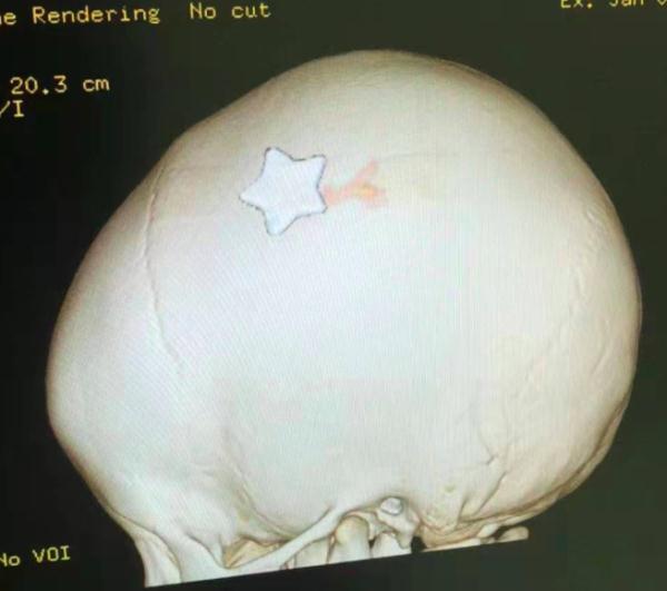 揪心！3岁女童从床上跌落，一颗钉子插入颅内......