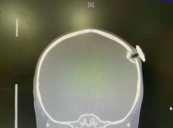 揪心！3岁女童从床上跌落，一颗钉子插入颅内......