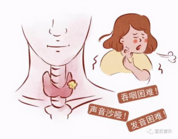 甲状腺癌的“自白”