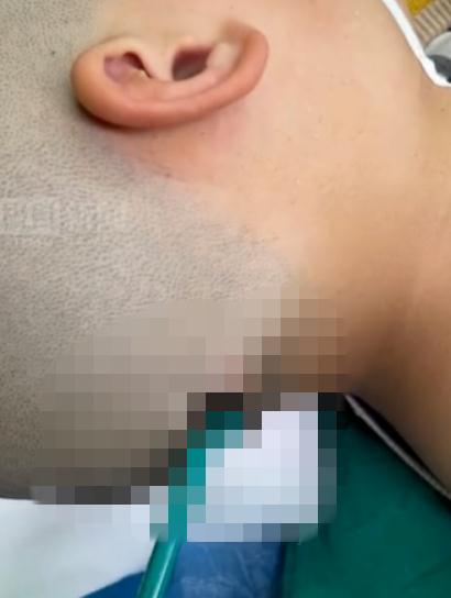 太吓人！铅笔插入8岁男孩后脑勺！只因……