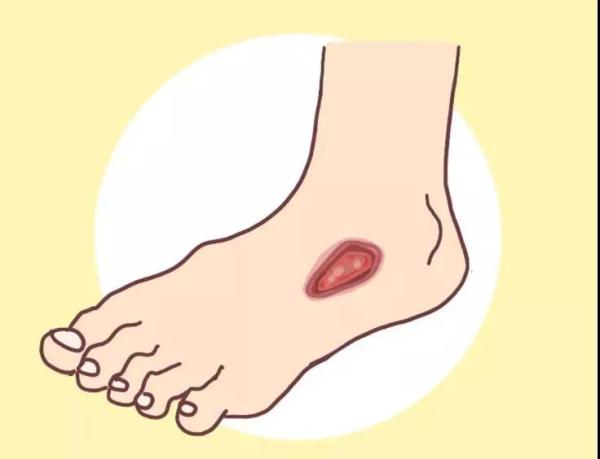 糖尿病足严重的可截肢，九类人群一定要重视