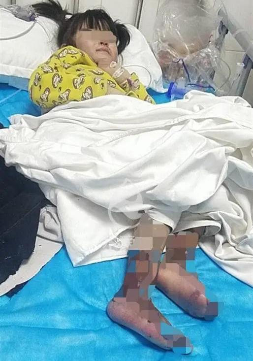4岁女童被殴打病危，双腿烫伤险要截肢！生父和女友被刑拘