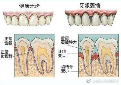 造成牙龈萎缩的原因有哪些？
