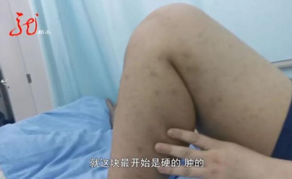 24岁壮小伙腿部不适，没想到几天后竟陷入病危！