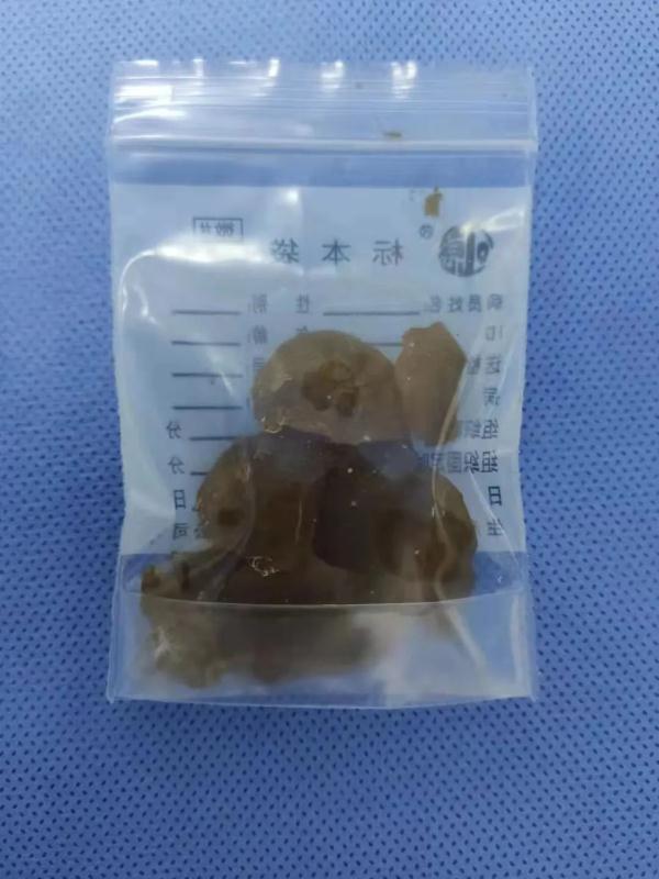 误吞这种玩具三个月，1岁男童腹胀如鼓