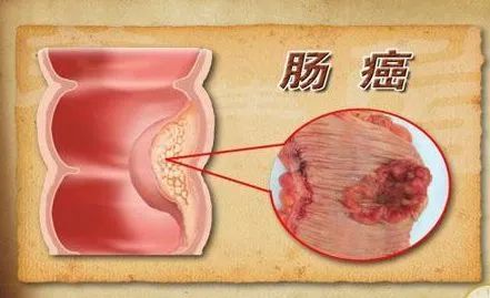 厦门一男子突然大量便血