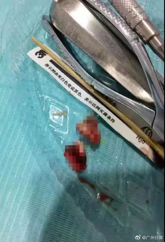 惊了！蛀牙里真的有“虫”！医生披露原因