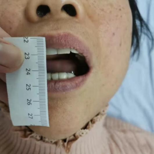 女子突然张不开嘴下巴罢工原来是遇上了它