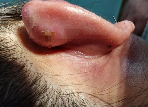 杭州姑娘花10块钱打耳洞,代价惨痛!医生提醒... 杭州姑娘花10块钱打耳洞,代价惨痛!医生提醒...