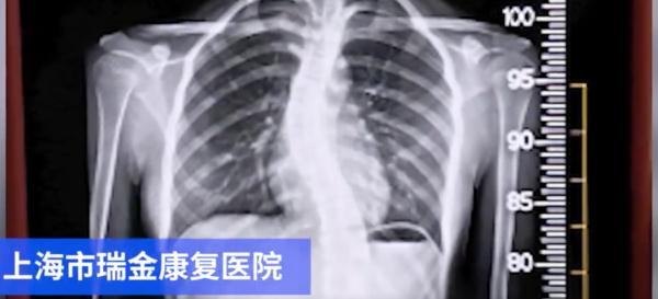 上海14岁女生背部植入20根长钉:我国中小学生脊柱侧弯人数超500万 上海14岁女生背部植入20根长钉:我国中小学生脊柱侧弯人数超500万
