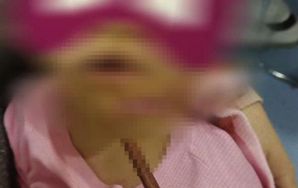 3岁女孩拿着筷子奔跑玩耍，不小心摔倒，结果扎入脸部