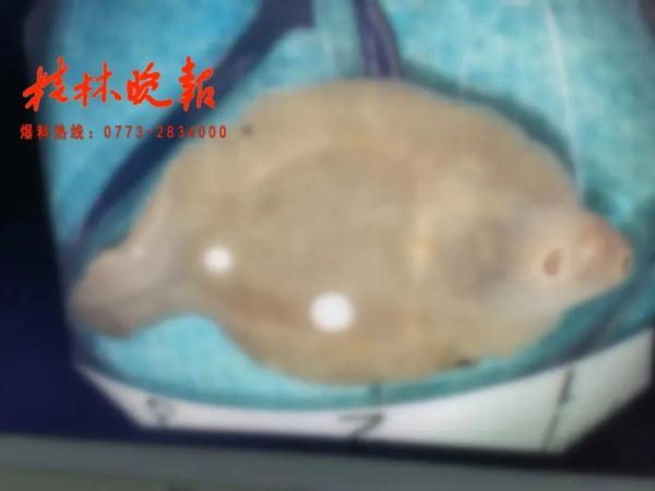 桂林女子肝脏被吃掉三分之一，“凶手”十分罕见，爱吃鱼腥草的人要注意