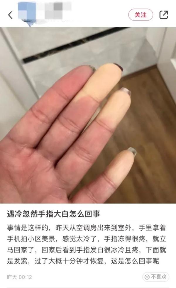 手指发白僵硬,冻伤了?其实是患上了这种极易被忽视的病!有人险些被截肢…… 手指发白僵硬,冻伤了?其实是患上了这种极易被忽视的病!有人险些被截肢……