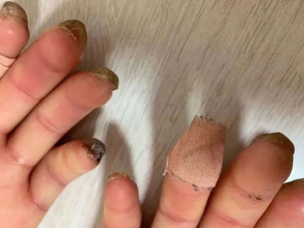 手指发白僵硬,冻伤了?其实是患上了这种极易被忽视的病!有人险些被截肢…… 手指发白僵硬,冻伤了?其实是患上了这种极易被忽视的病!有人险些被截肢……