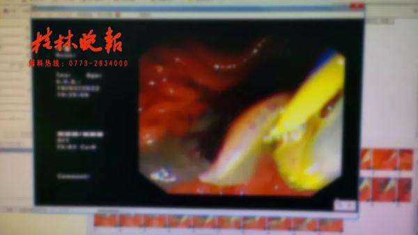 桂林女子肝脏被吃掉三分之一，“凶手”十分罕见，爱吃鱼腥草的人要注意