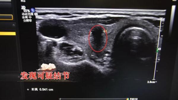 甲状腺结节即便不癌变也有这两大危害中医妙方调气血平阴阳守护甲状腺