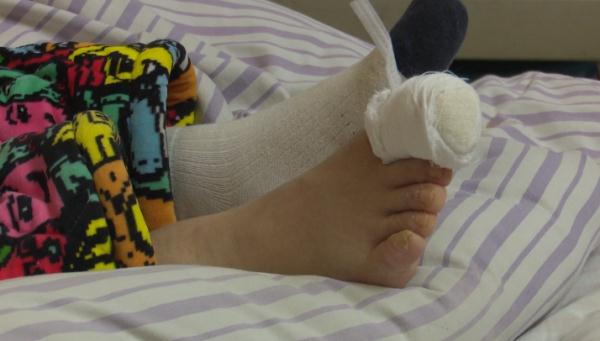 湖南女子围炉烤火脚趾头被烧焦却没感觉，消防提醒：烤火时不注意这点很危险