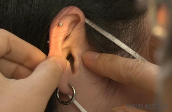 18岁女孩戴耳机“上瘾”，左耳突然聋了