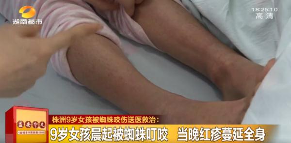 千万小心!持续升温,它们开始活跃!湖南女孩因此全身红疹肿胀…… 千万小心!持续升温,它们开始活跃!湖南女孩因此全身红疹肿胀……