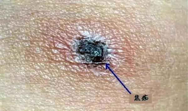 小心!一升温就活跃,有女孩因此全身红疹肿胀… 小心!一升温就活跃,有女孩因此全身红疹肿胀…