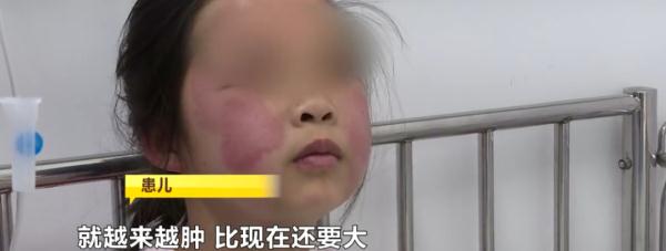 小心!一升温就活跃,有女孩因此全身红疹肿胀… 小心!一升温就活跃,有女孩因此全身红疹肿胀…