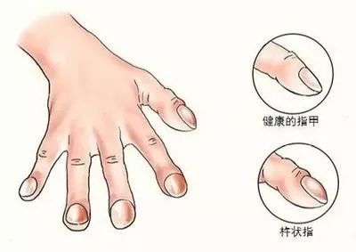 手上这部位鼓起！表明你的心脏：正在向你发出求救！