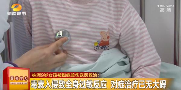 女孩被蜘蛛咬伤,全身红肿起疹吓坏家长 女孩被蜘蛛咬伤,全身红肿起疹吓坏家长