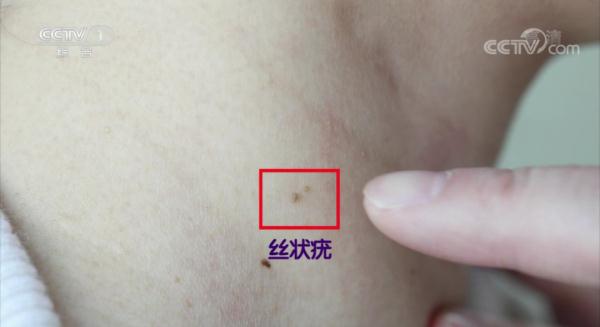 高危型hpv 初期图片