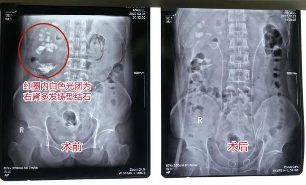 男子患结石多年放任不管，如今肾脏长出“石头花”险得尿毒症