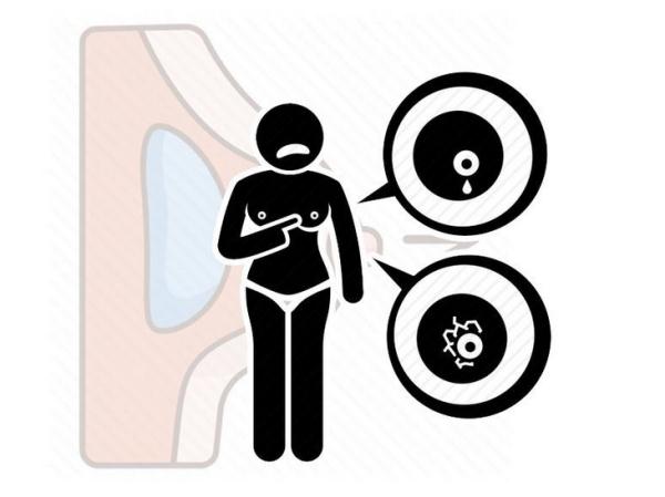 女子乳房长湿疹却查出乳腺癌:乳房出现3种异样,女性可得要小心 女子乳房长湿疹却查出乳腺癌:乳房出现3种异样,女性可得要小心