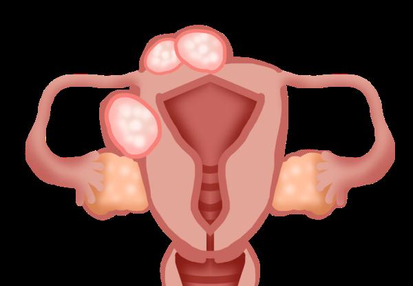 11岁女孩腹痛3天，最终卵巢没能保住……