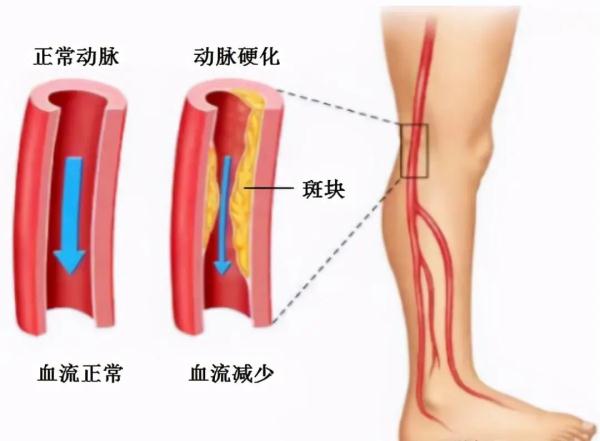 老人腿麻、怕冷，有可能是下肢血管“堵”了