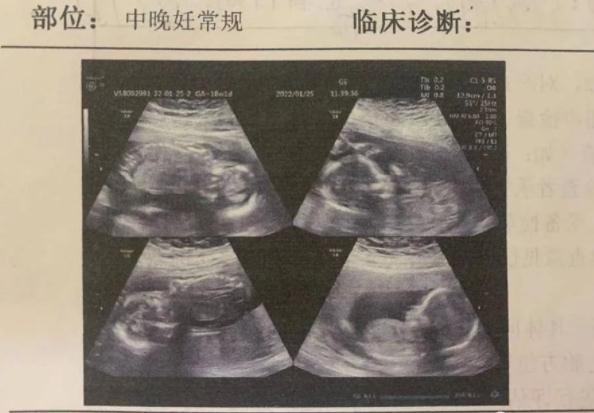 四胞胎两个早产 两个还在妈妈肚里