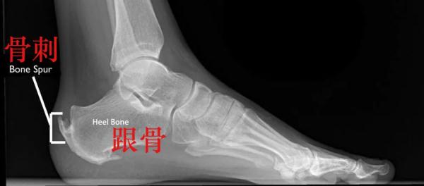 总是足跟痛？你可能患上了跟腱炎
