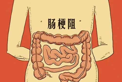 饭后剧烈运动，饭后一动不动，都要小心这种肠道急症