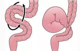饭后剧烈运动，饭后一动不动，都要小心这种肠道急症