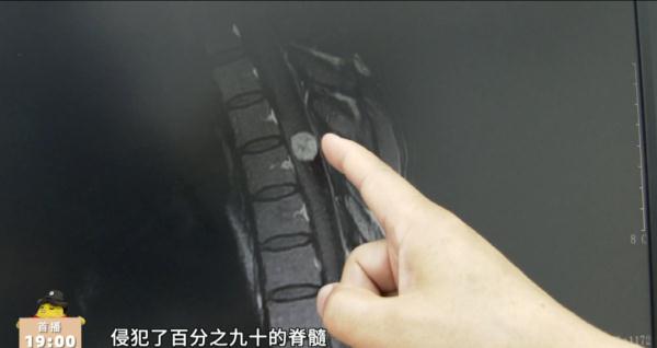 女子走路就像“喝醉酒”，一查“元凶”竟是…