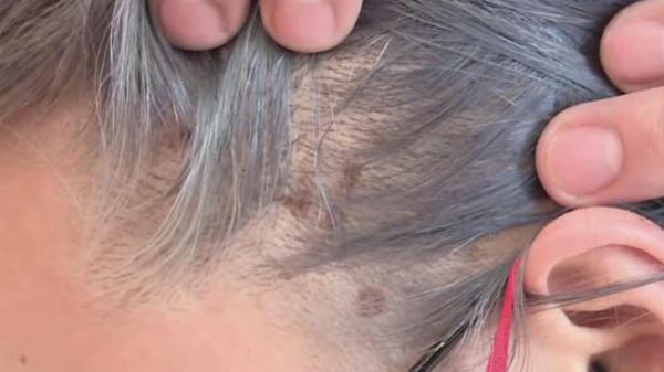 染个头发,最后颜色货不对板头皮还起水泡? 染个头发,最后颜色货不对板头皮还起水泡?