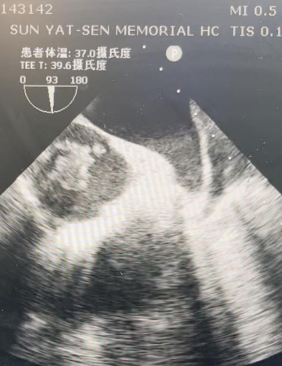 罕见!子宫肌瘤钻进心脏,多学科团队联手“拆弹” 罕见!子宫肌瘤钻进心脏,多学科团队联手“拆弹”