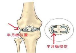 有种膝盖疼，竟是因股骨头坏死而起？
