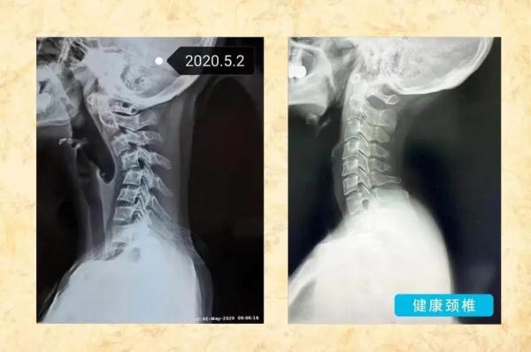 这种病，再不注意，或摧毁“生命枢纽”……
