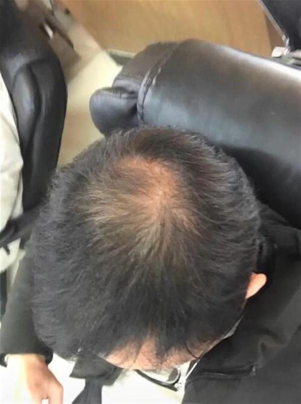 秃顶男子半月不用洗发水长出新头发，专家提醒：不适用于所有人