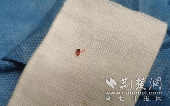 假期出游后腿上突然长出了“痣”  原来竟是蜱虫作怪