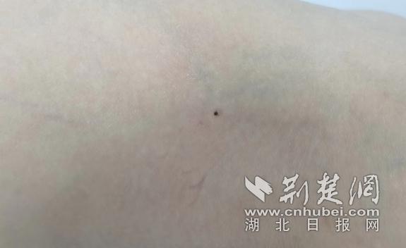 假期出游后腿上突然长出了“痣”  原来竟是蜱虫作怪