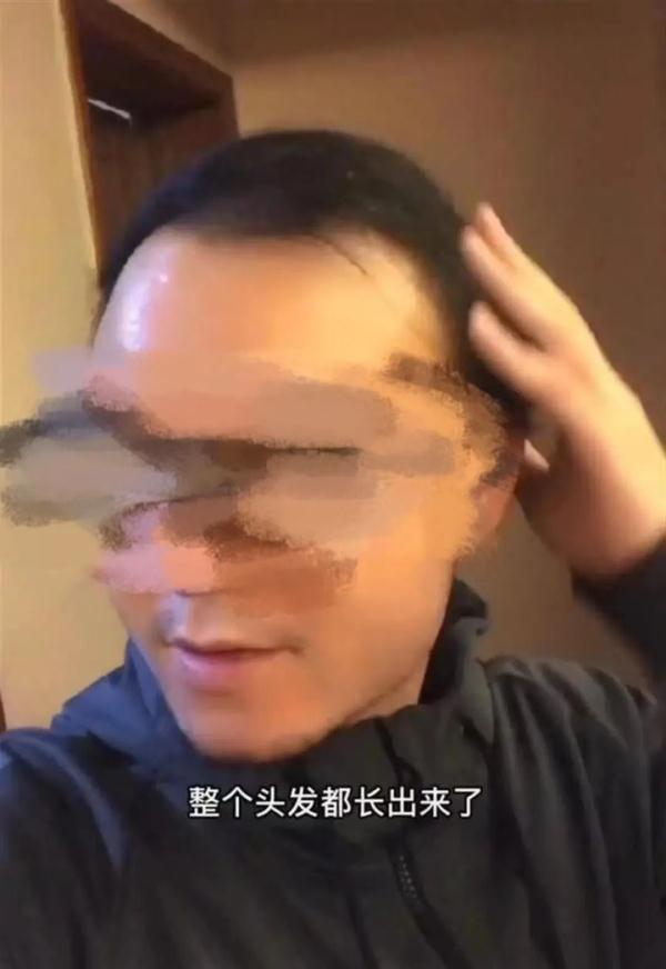 男子秃顶不用洗发水半个月后,网友惊呆了!专家提醒… 男子秃顶不用洗发水半个月后,网友惊呆了!专家提醒…